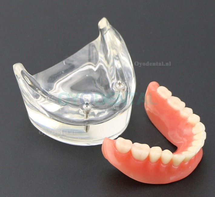 Tandentandenmodel Overdenture Inferieur met 2 implantaten Studiedemo Model 6002 01